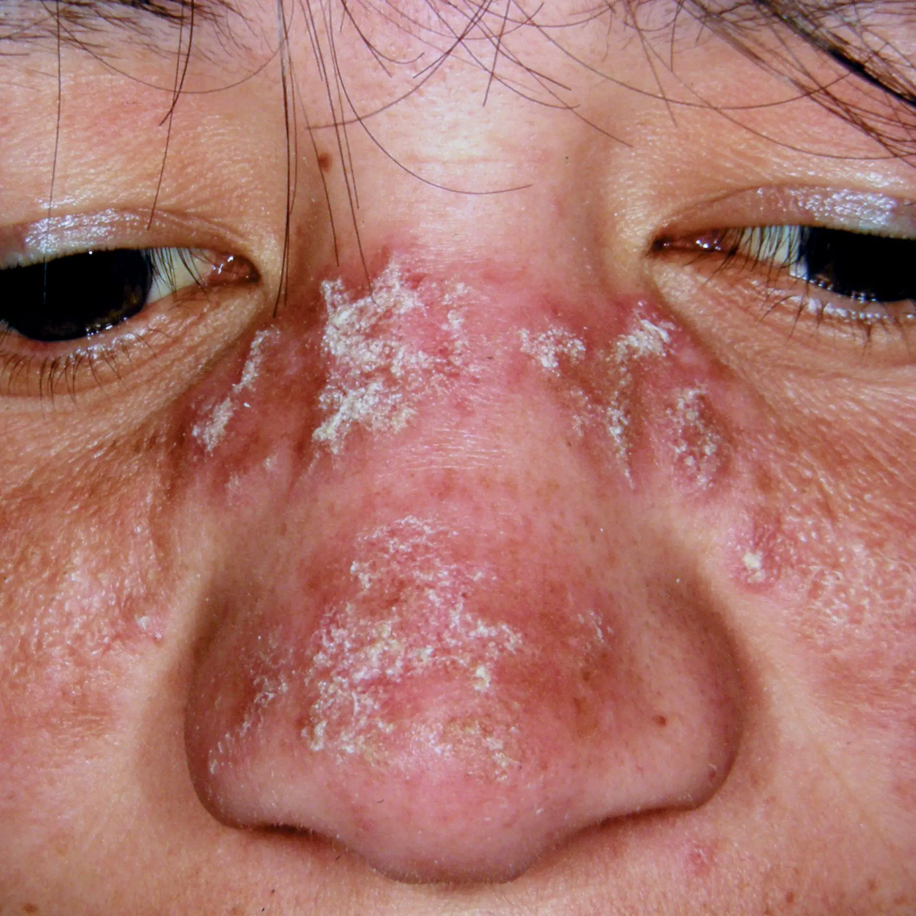 18+ Skin Rashes With Lupus