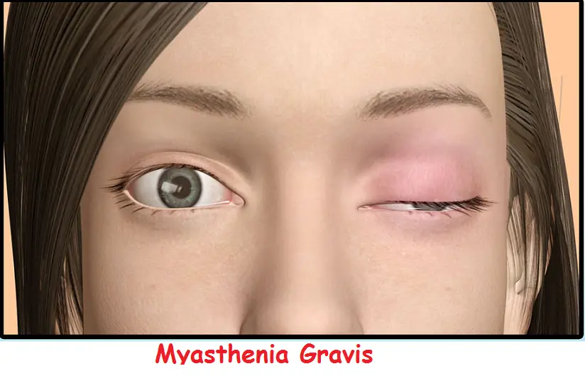 5 Useful Natural Remedies for Myasthenia gravis to Lessen ...