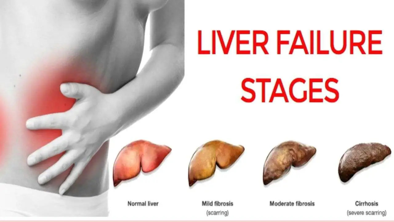 6 BEST HOME REMEDY FOR LIVER FAILURE