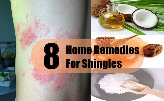 8 Home Remedies For Shingles