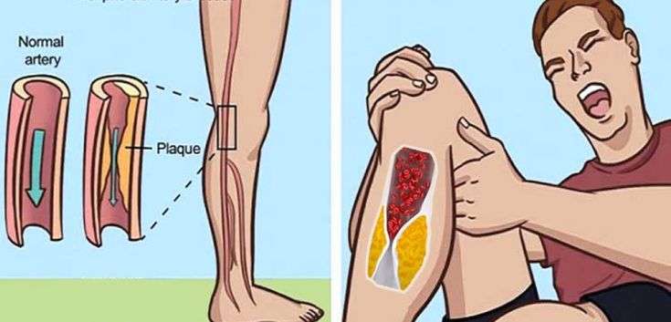 Be Careful About These 7 Signs Of Blocked Arteries! Visit Your Doctor ...