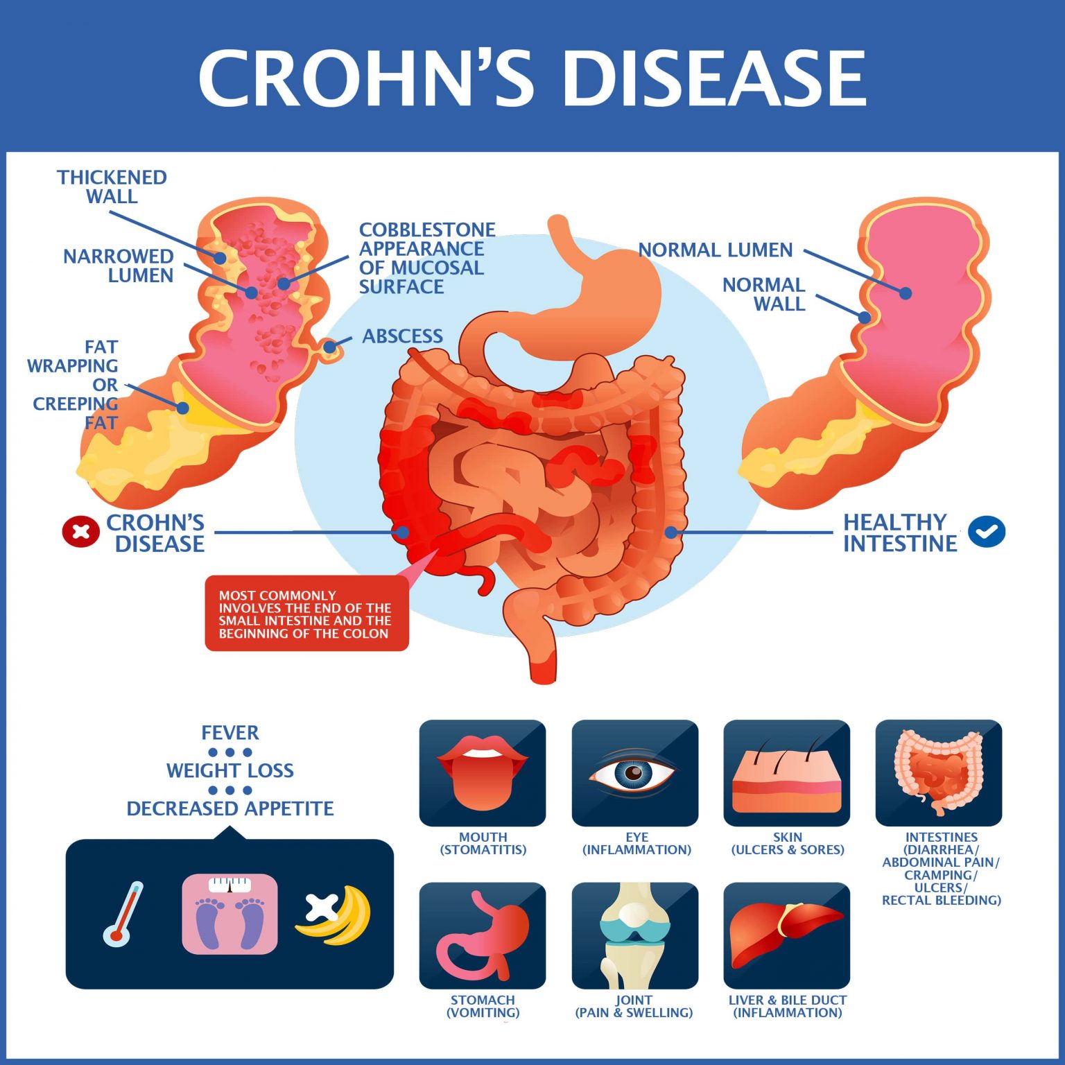 Been Diagnosed With Crohnâs Disease?