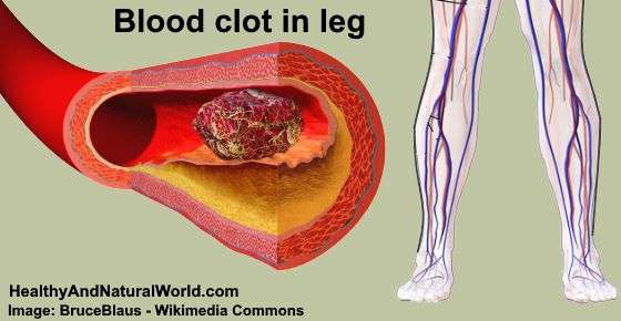 Blood Clot in Leg: Signs, Symptoms, and Treatment ...