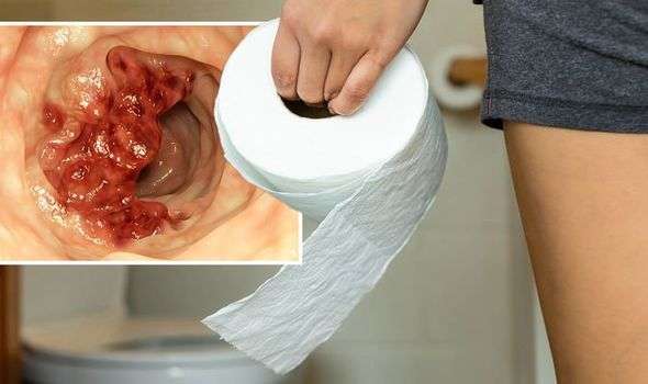 Bowel cancer symptoms: Signs include loose stool motions