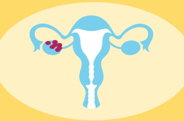 Can an ovarian cyst affect the mood and cause depression and fatigue ...