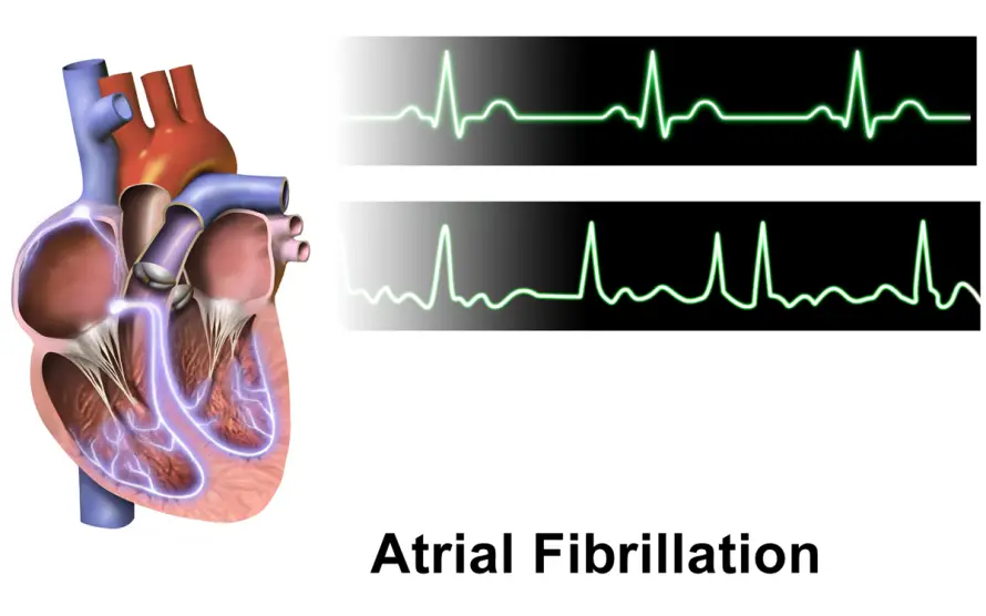 Cardiology 101  Atrial Fibrillation (USMLE) : Causes, Symptoms ...
