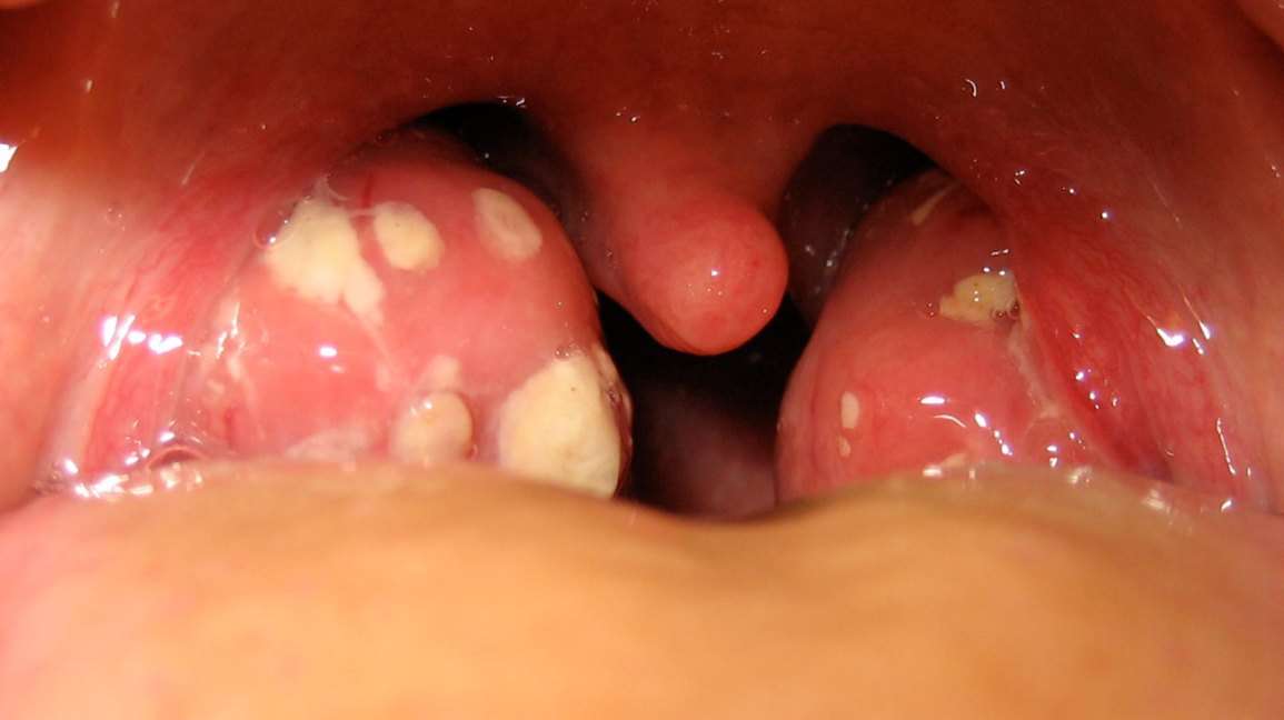 Causes of swollen tonsils: Pictures, and treatment ...