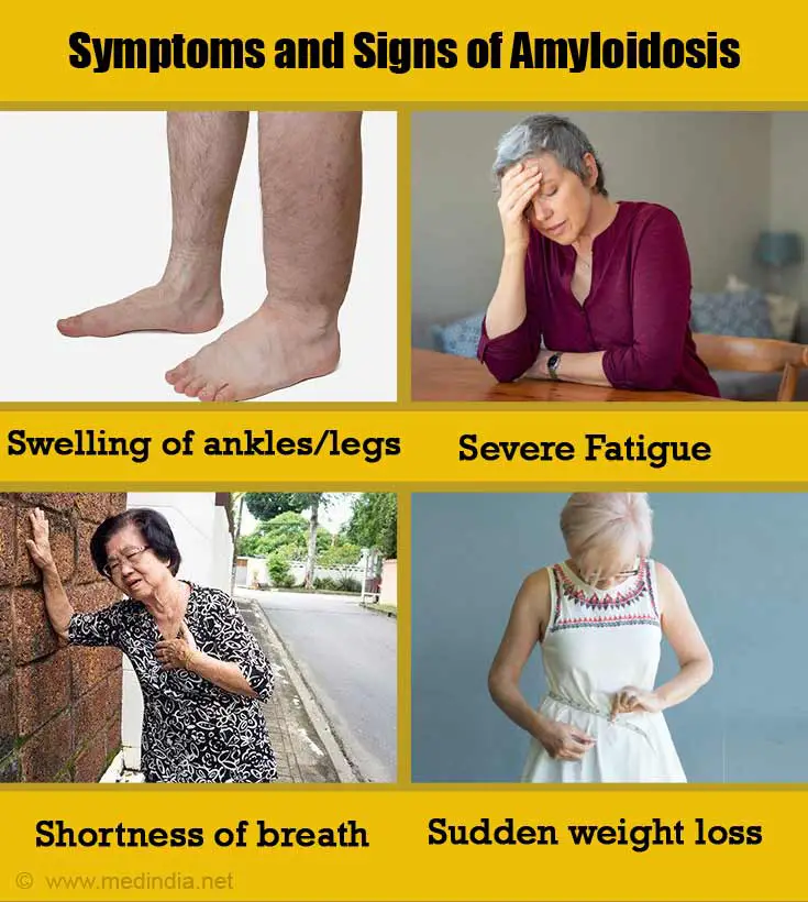 Causes, Symptoms and Signs of Amyloidosis