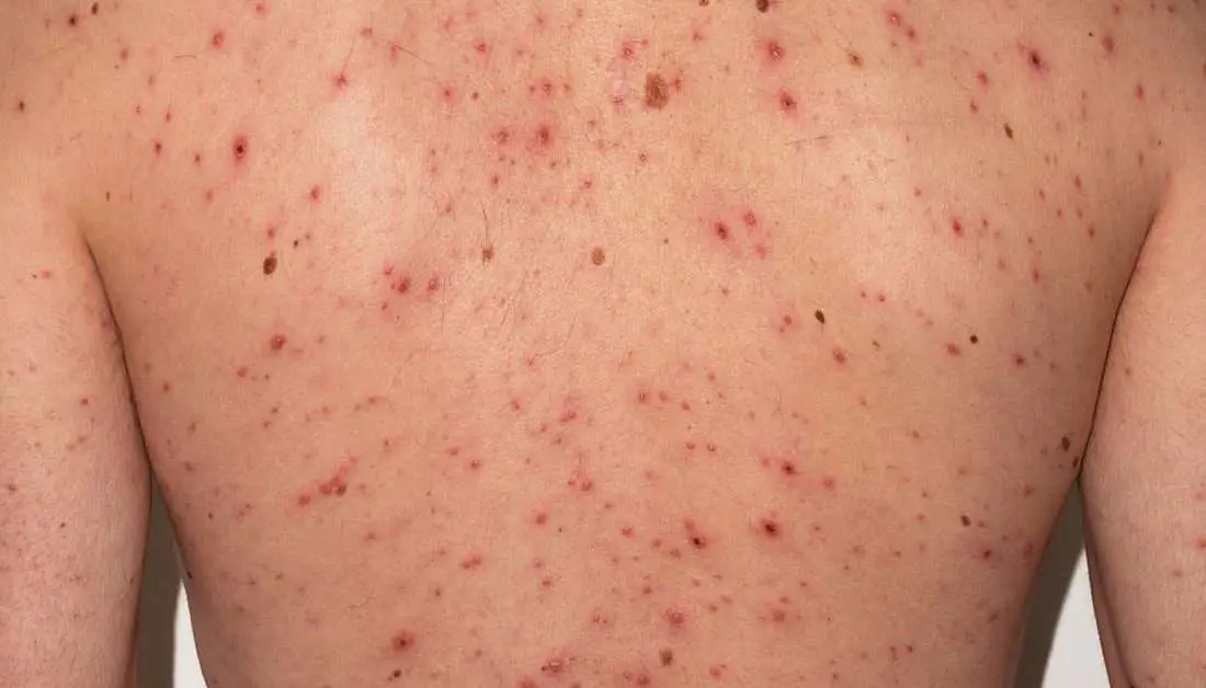 Chickenpox in adults: Symptoms, treatments, and vaccination