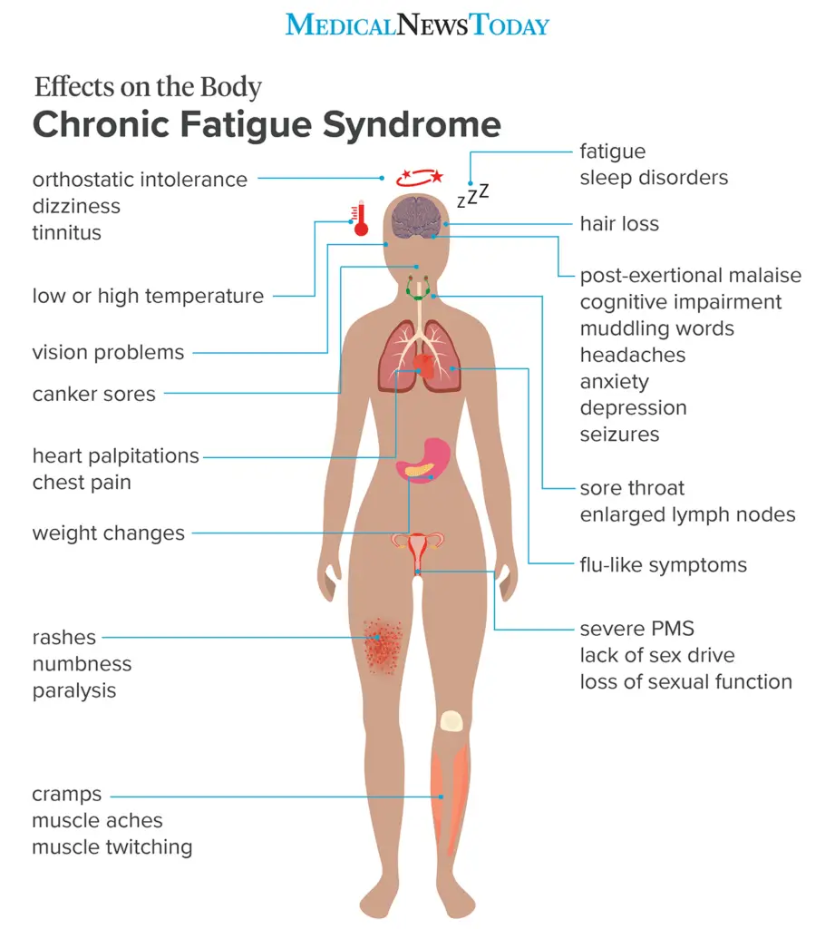 Chronic fatigue syndrome: Symptoms, treatment, and causes