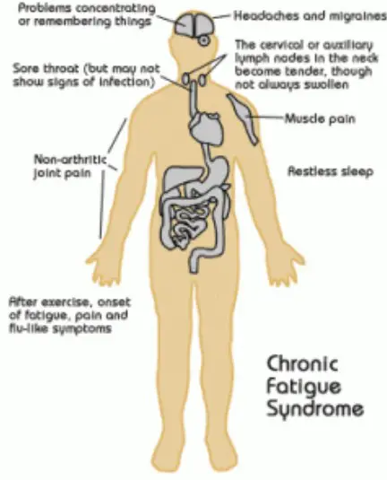 Chronic Fatigue Syndrome : Treatment, prevention, causes and herbal ...