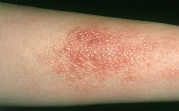 Common Skin Rashes, Causes and Treatment