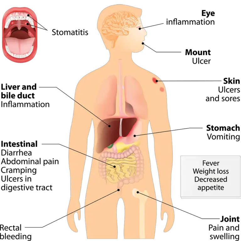 Crohnâs Disease â Alfred Gastroeneterology