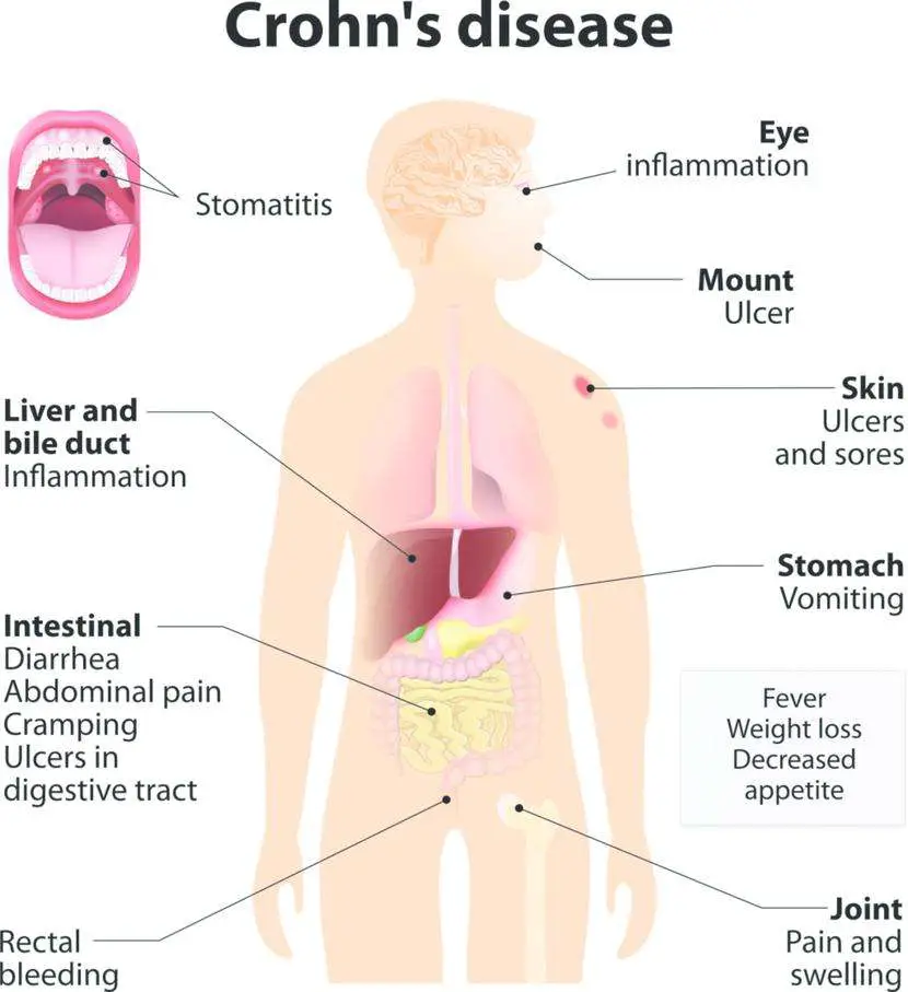Crohns Disease: Symptoms, Causes, Treatment, and ...