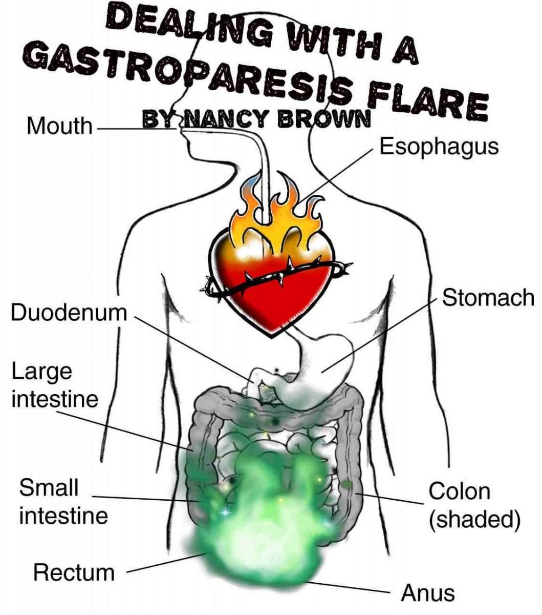 Dealing with a Gastroparesis Flare by Nancy Brown 7/3/17 What is a ...