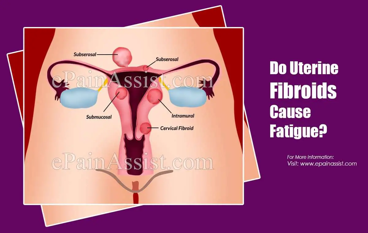 Do Uterine Fibroids Cause Fatigue?