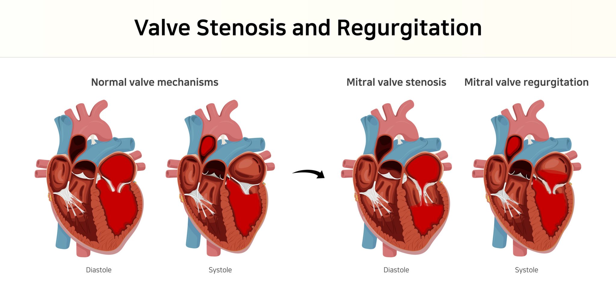 East Tennessee Cardiovascular Surgery Group Heart Valve Disease