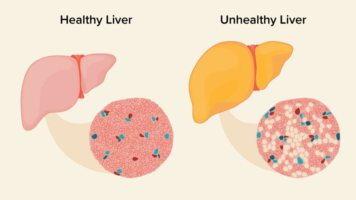 Fatty Liver: Causes, Symptoms, and Diagnosis
