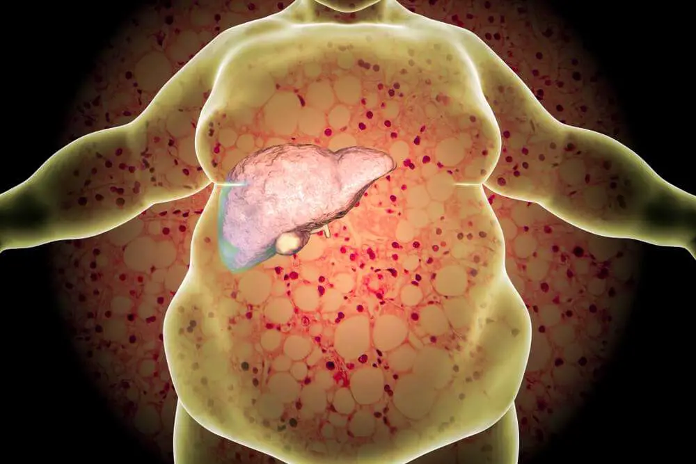 Fatty Liver Disease, Alcohol