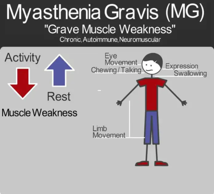 Featured Research: Improving Treatment for Myasthenia Gravis