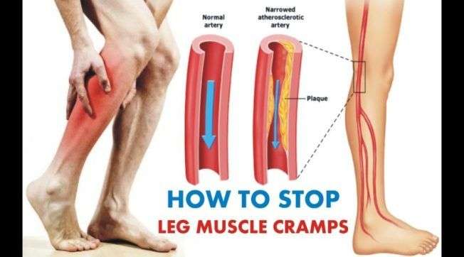Fibromyalgia and Leg Cramps. What You Should Know