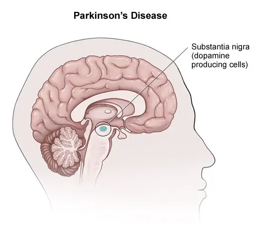 Get Safe Homeopathic Treatment for Parkinson