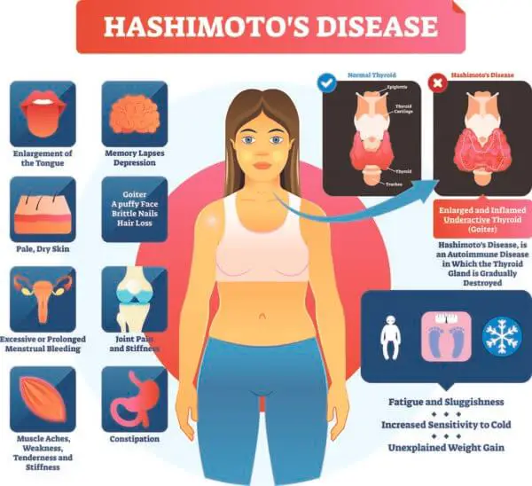 Hashimotos Syndrome Symptoms, Causes &  Treatments