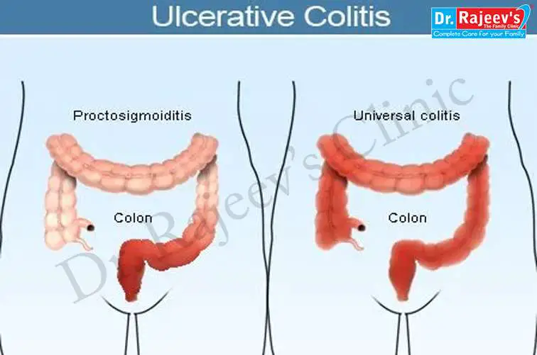 Homeopathic Treatment for Ulcerative Colitis, Treatment of Ulcerative ...