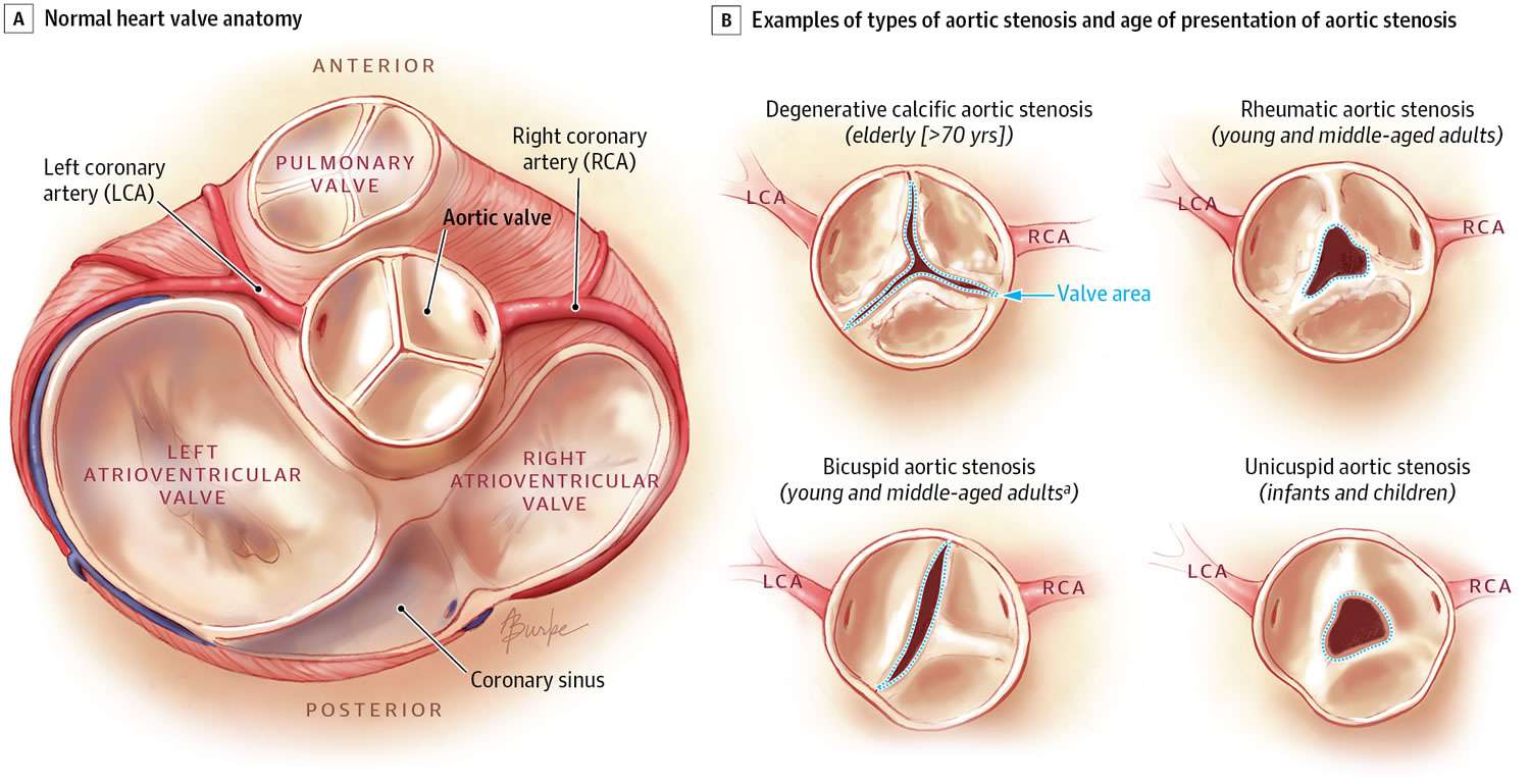How To Repair A Leaky Heart Valve
