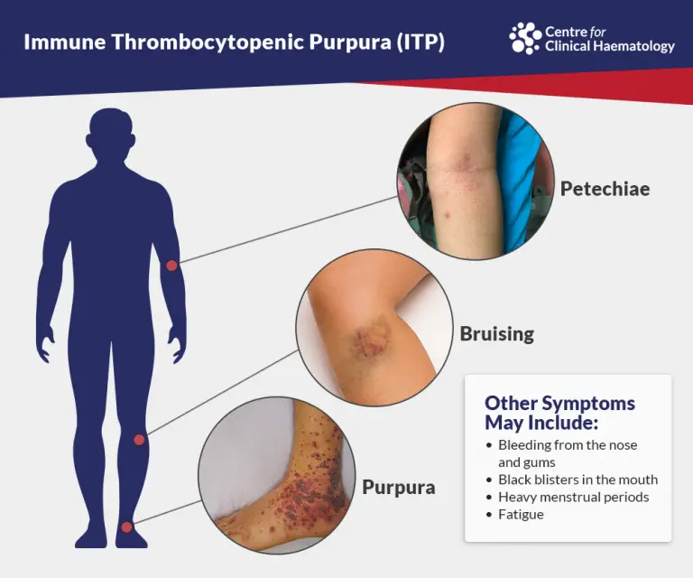 Immune Thrombocytopenia