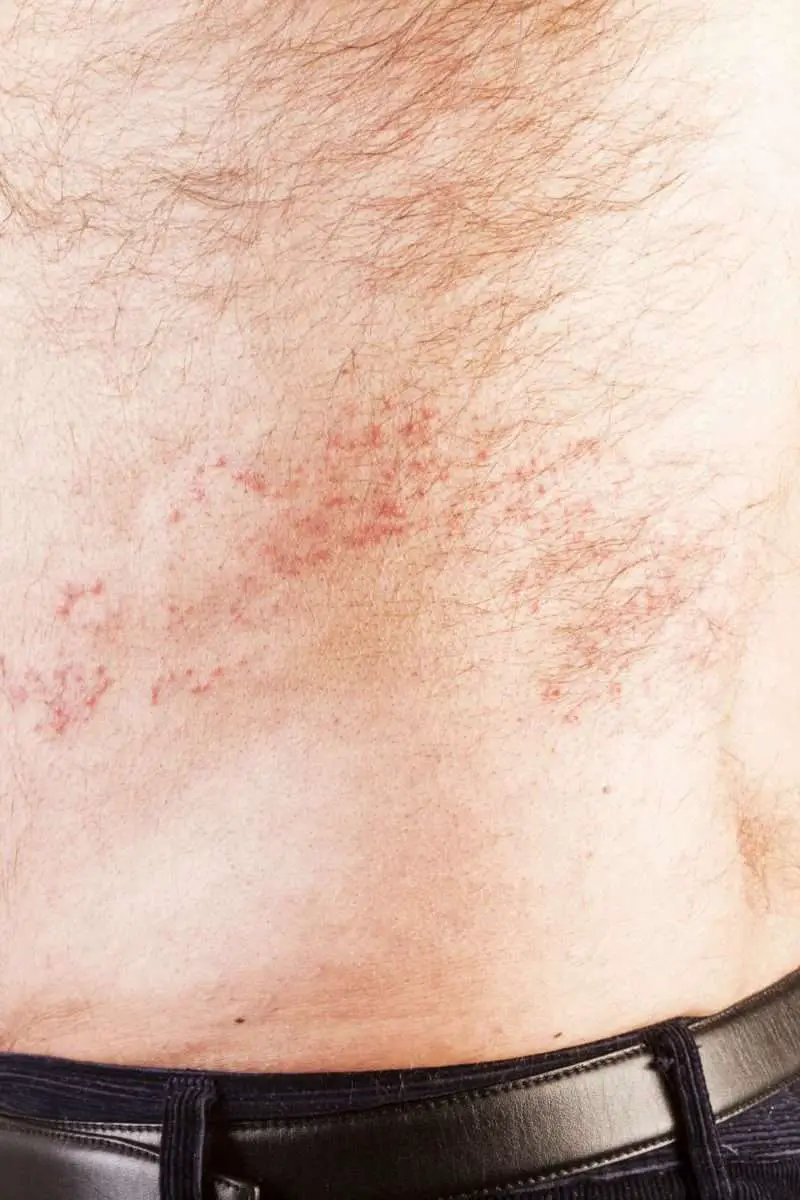 Is it shingles? Symptoms, vs. other conditions, and causes
