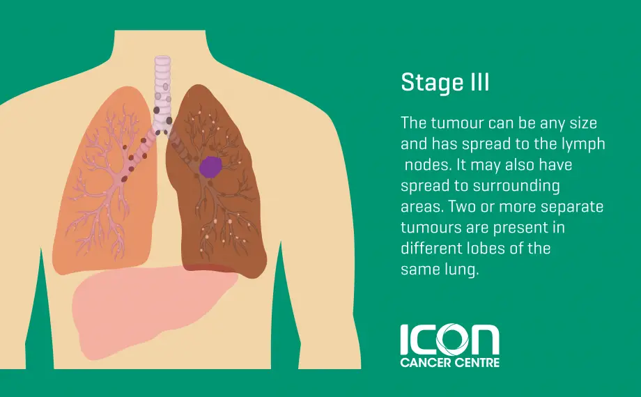 Lung Cancer Types &  Stages