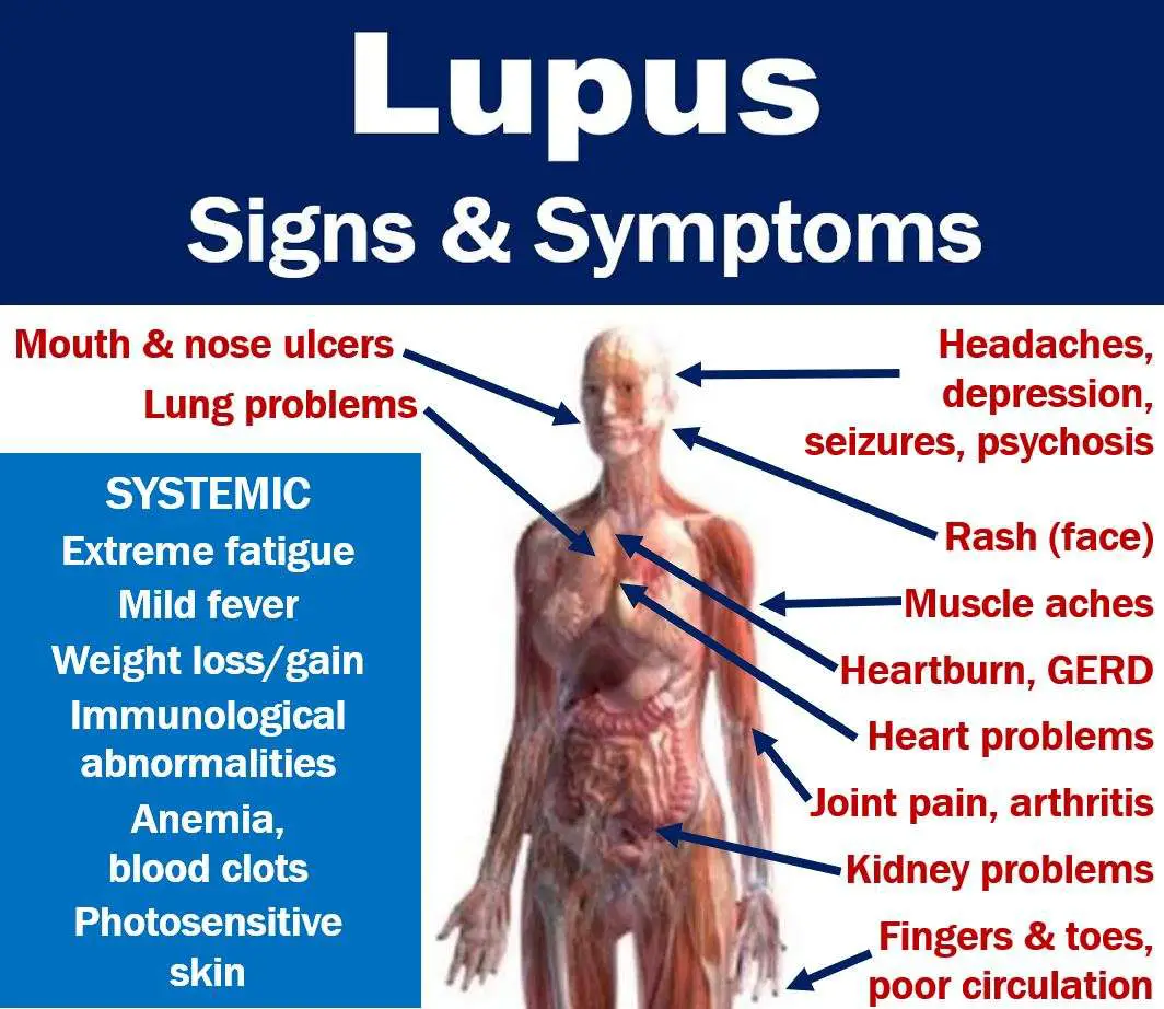Lupus signs and symptoms with full description of features