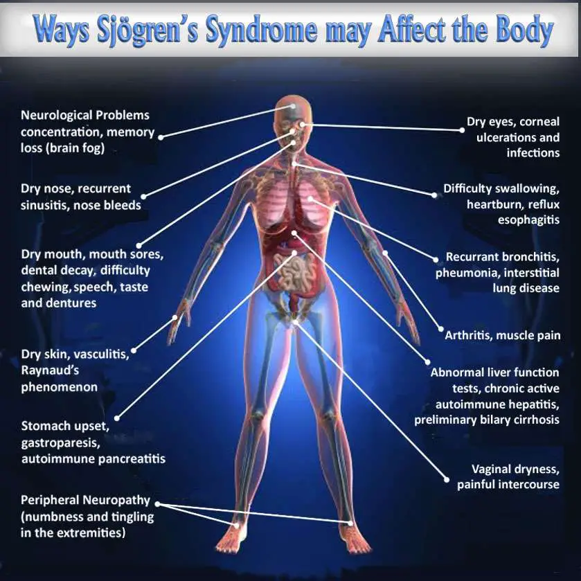 Many Symptoms Of Sjogren