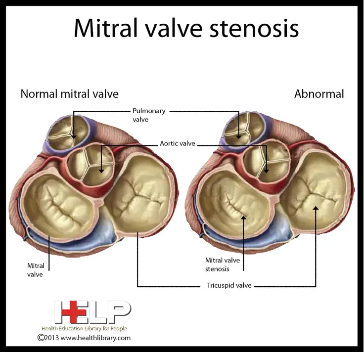 Mitral Valve Stenosis Dyspnea, Fatigue, orthopnea LA