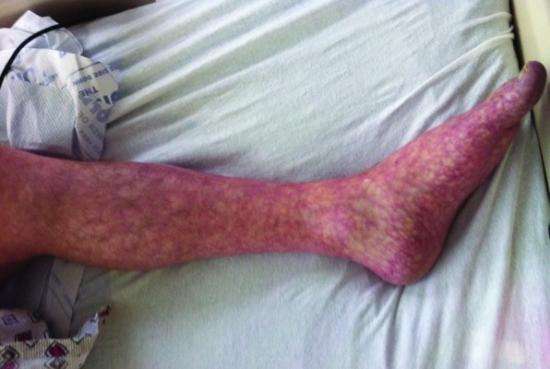 Mottled skin (livedo reticularis): Causes, treatment and ...