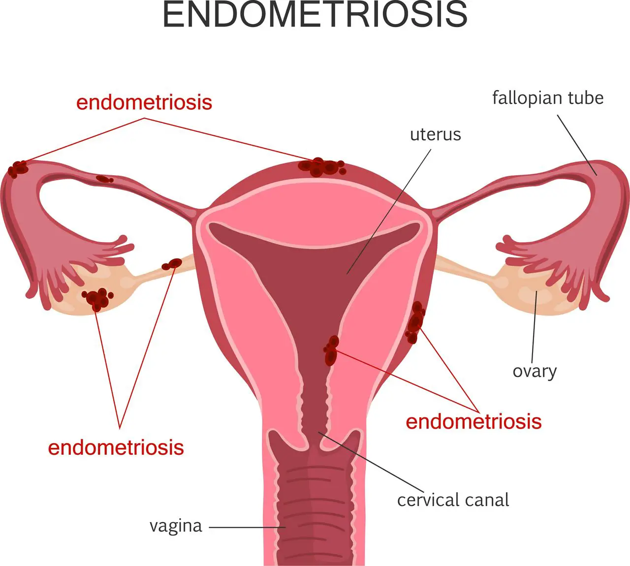Norton Gynecologist Explains Fibroids and Endometriosis