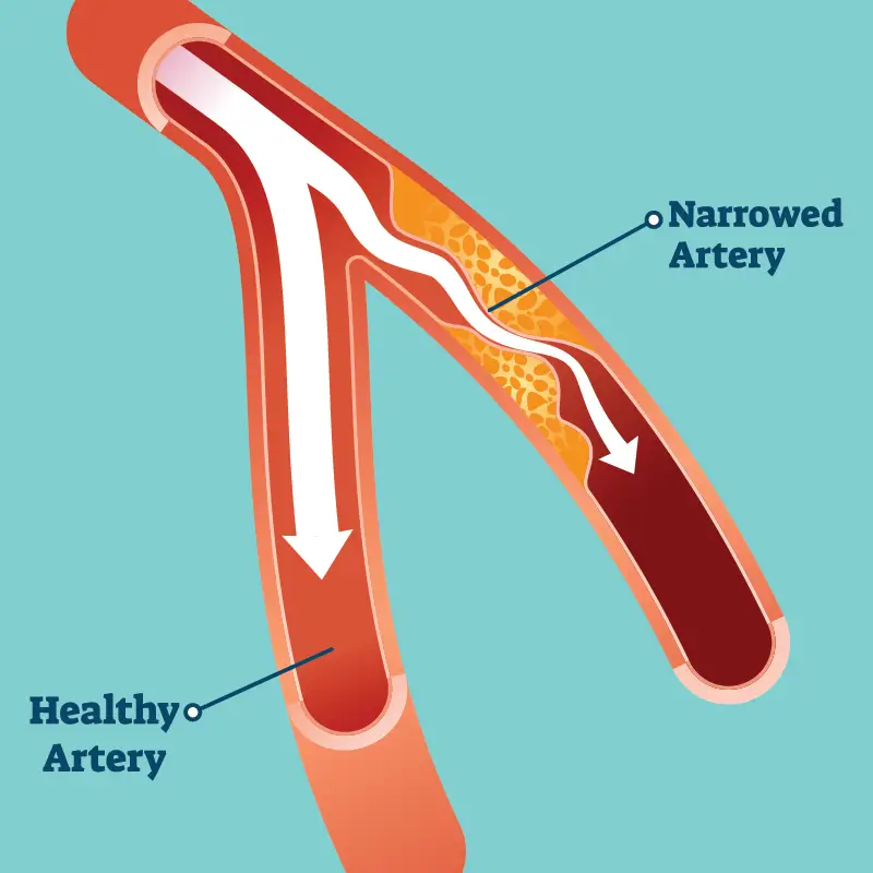 Peripheral Artery &  Vascular Disease