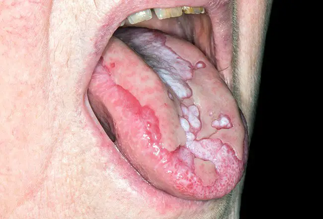 Picture of Lichen Planus (Oral) on MedicineNet