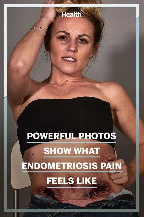 Pin on Endometriosis pain