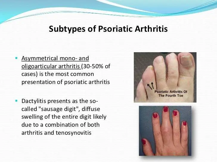 Psoriatic Arthritis and Connection to Diet: an ...