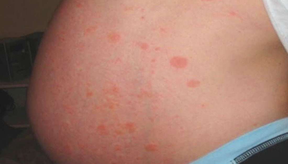 PUPPP rash in pregnancy: Natural treatments and prevention
