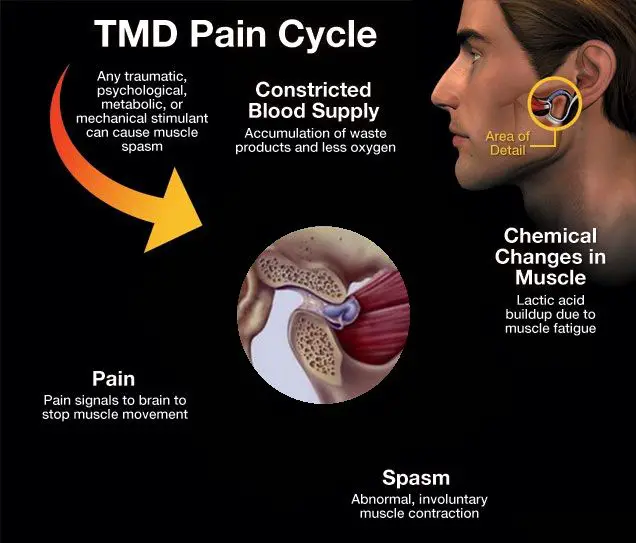 Read about #TMJ symptoms and treatments. #TMD #facialpain ...