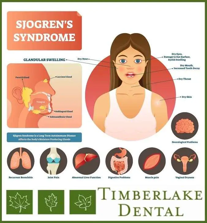 Sjögrens Syndrome