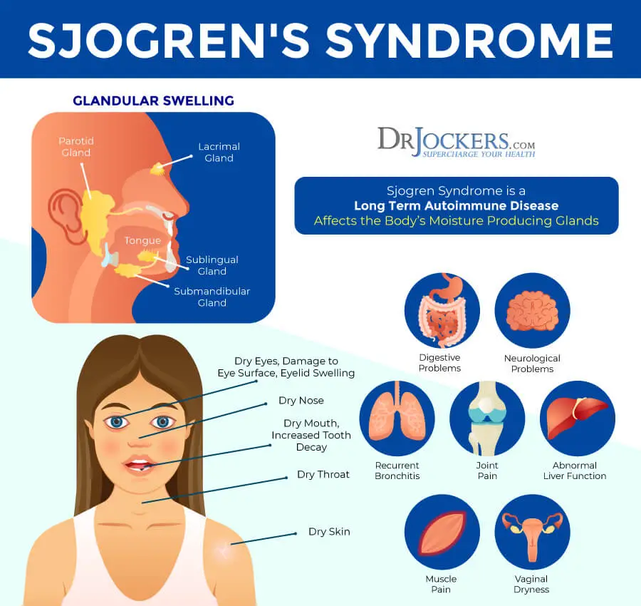 Sjogrens Syndrome: Symptoms, Causes, and Natural Support ...
