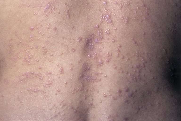 Skin Manifestations of Chronic Hepatitis C Virus Infection
