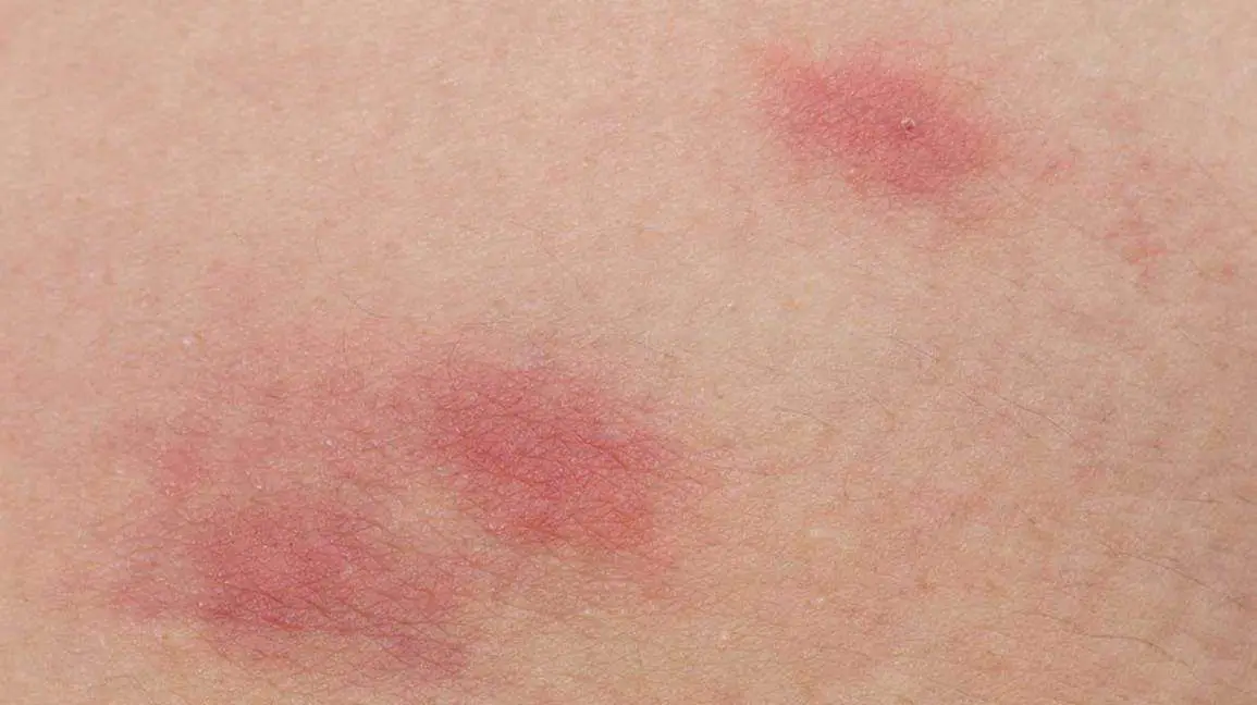 Skin Rash: Pictures, Causes, Types, and Treatments