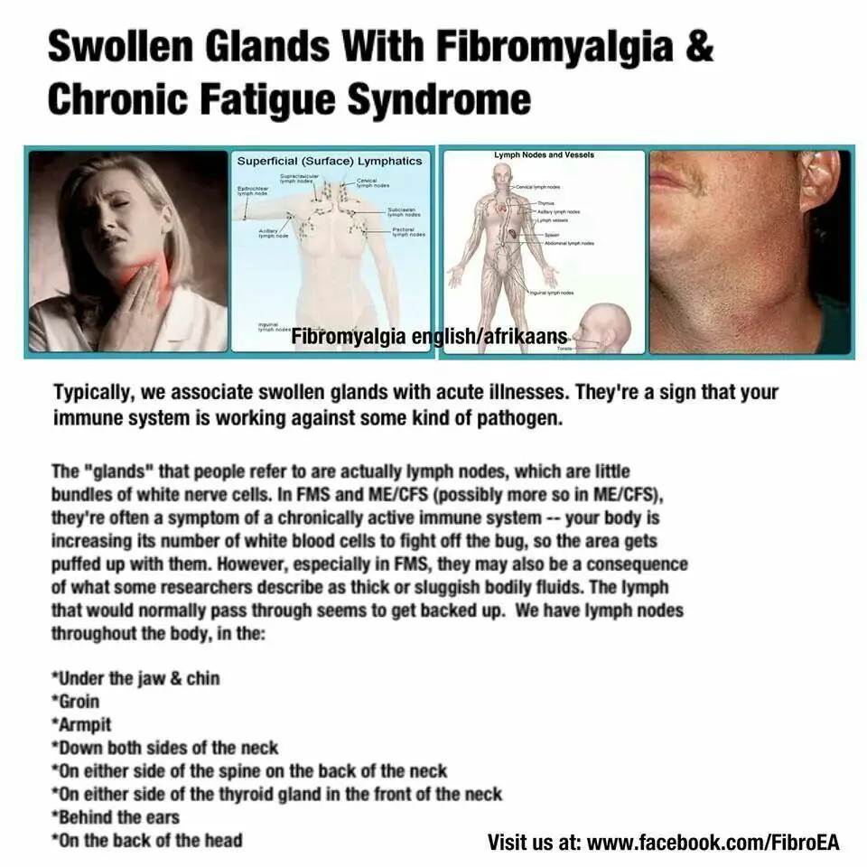Swollen Lymph Nodes Joint Pain Fatigue