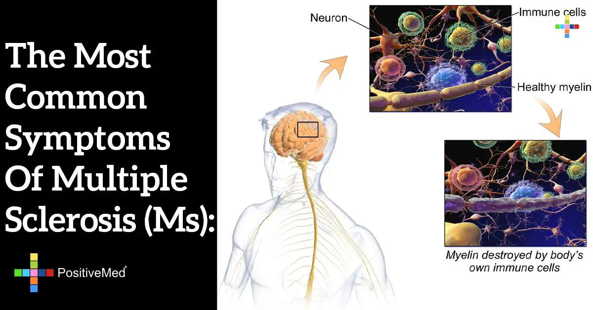 The most common symptoms of multiple sclerosis (MS ...