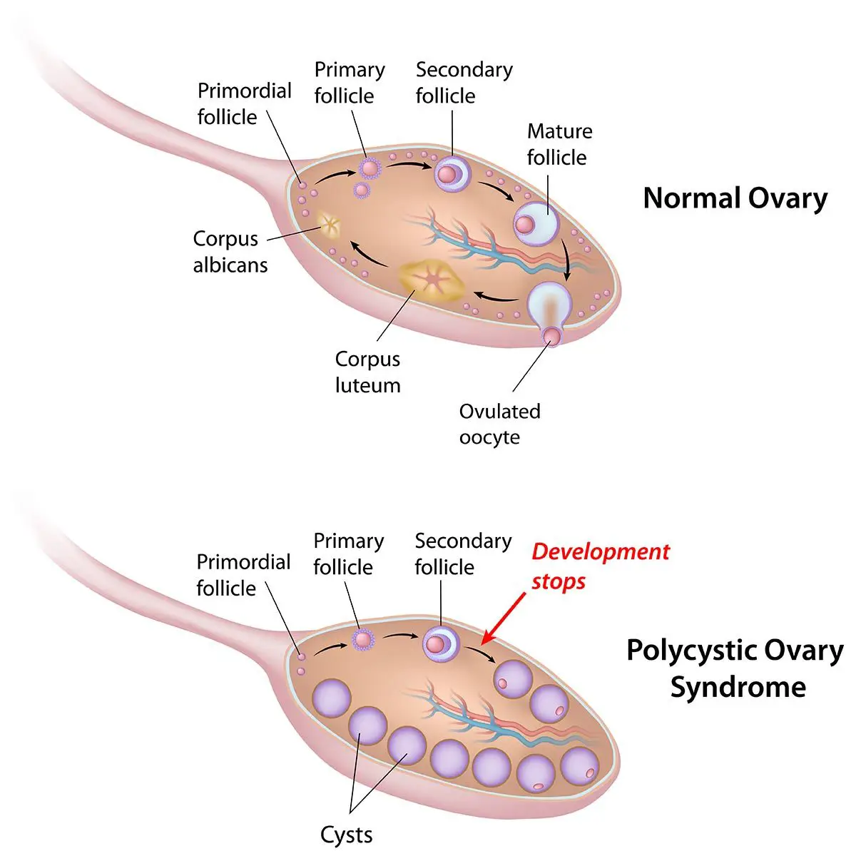 Treating Polycystic Ovaries with PEMF